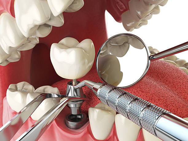 Best Emergency Dental Care for Abscessed Tooth in Patterson Tract, CA